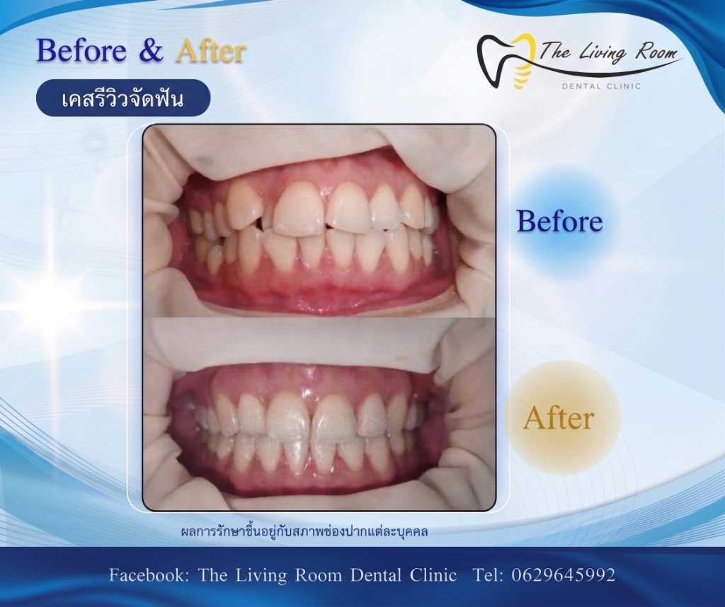 Veneers 1